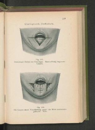 Fig. 152. Dreieckiger Defekt der Unterlippe. Rautenförmig begrenzte Lappen.