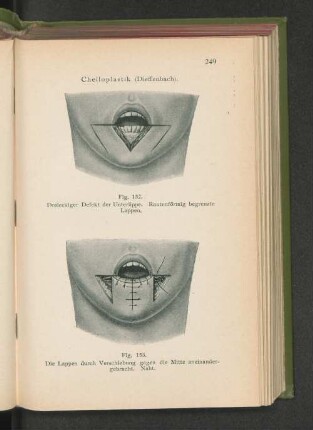 Fig. 152. Dreieckiger Defekt der Unterlippe. Rautenförmig begrenzte Lappen.