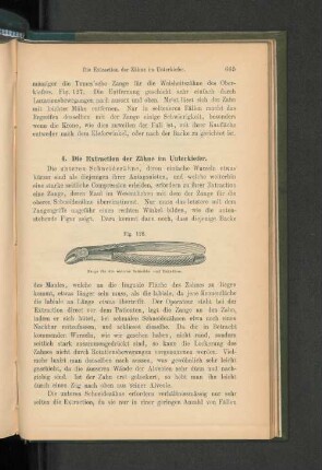 4. Die Extraction der Zähne im Unterkiefer.