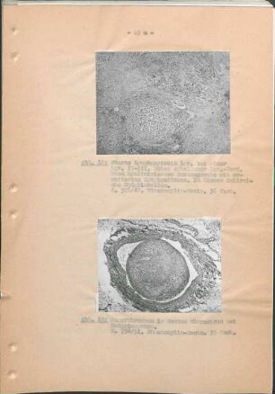 Abb. 12: Starke Lymphangiosis lgt. bei einer Lgr. II-III. Abb. 13: Tumorthrombus im Ductus thoracicus bei Hodgkinsarkom.