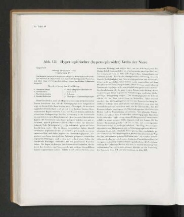 Abb. 121 Hypernephrischer (hypernephroider) Krebs der Niere