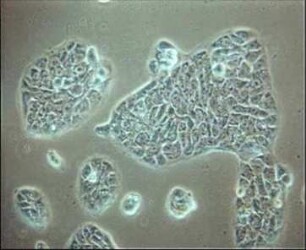 Different Keratinocyte Cultures - Effect of Liposomes and Dithranol