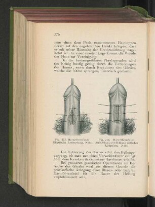 Fig. 213. harnröhrenfistel. Elliptische Anfrischung Naht.
