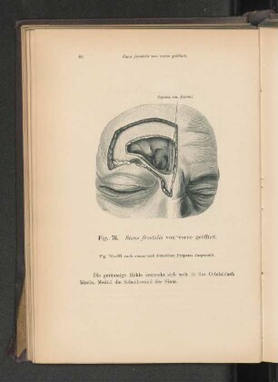 Fig. 76. Sinus frontalis von vorne geöffnet.