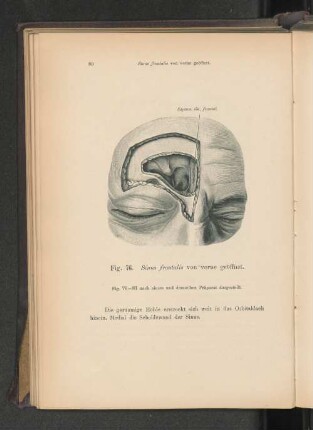 Fig. 76. Sinus frontalis von vorne geöffnet.