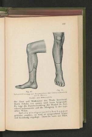 Fig. 67 u. 68. Schnittführung zur Amputation des Unterschenkels nach Heine. Vorder- und Seitenansicht.