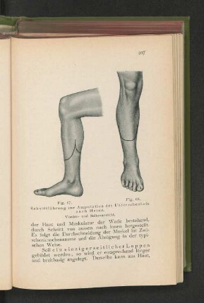 Fig. 67 u. 68. Schnittführung zur Amputation des Unterschenkels nach Heine. Vorder- und Seitenansicht.