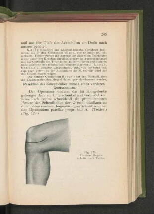 Resektion des Kniegelenkes mittels eines vorderen Querschnittes.