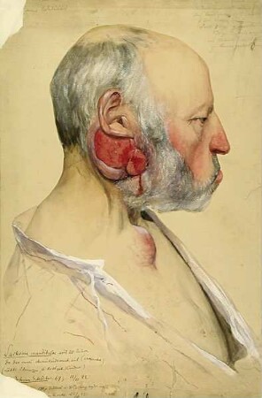 Sarcoma mandibulae. Krankenbildnis Johann Schlüter