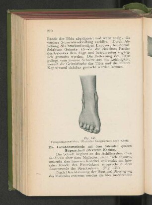 Fig. 132. Fussgelenksresektion; bilateraler Längsschnitt nach König.