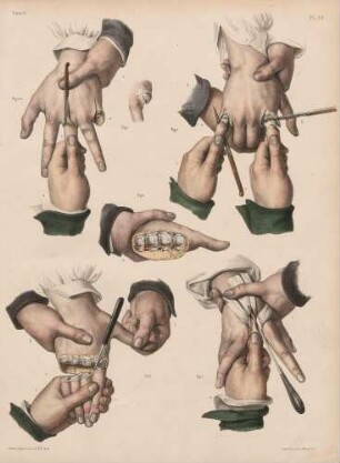 Amputationen an der Hand