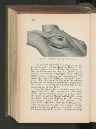 Fig. 188. Amputatio mammae. Hautschnitt.