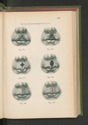Fig. 161 - 166. Hasenschartenoperationen.
