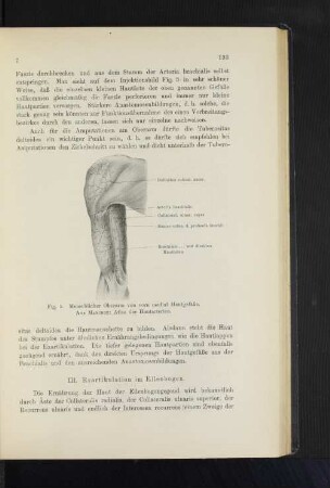 III. Exartikulation im Ellenbogen.