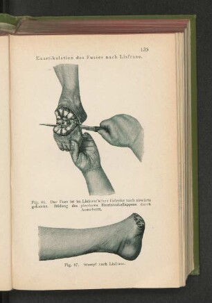 Fig. 87. Stumpf nach Lisfranc.