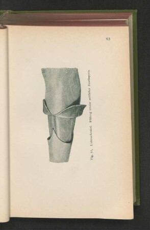 Fig. 61. Unterschenkel, Bildung zweier seitlicher Hautlappen.