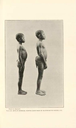 Plate LVI. Boys of Zambales, showing scars made by blistering for fevers, etc
