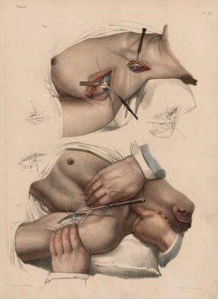 Ligatur der Arteria humeralis, subclavia und carotis