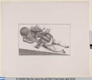 Anatomische Darstellung eines missgebildeten Kindes, auf dem Bauch liegend