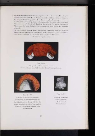 Figur Nr. 397 Gingivitis fibro-sareomatosa.