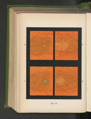 Fig. 53. Erkrankung der Macula lutea der Netzhaut durch Fremdkörper im Glaskörper.
