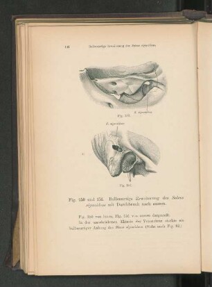 Fig. 150-151. Bulbusartige Erweiterung des Sulcus sigmoideus mit Durchbruch nach aussen.