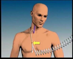 Bone Marrow Transplantation - Schedule of a Treatment