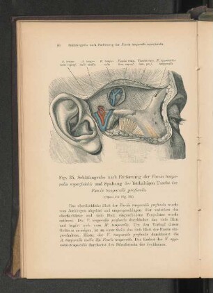 Fig. 35. Schfäfengrube nach Entfernung der Fascia temporalis superficialis und Spaltung der fetthaltigen Tasche der Fascia temporalis profunda.