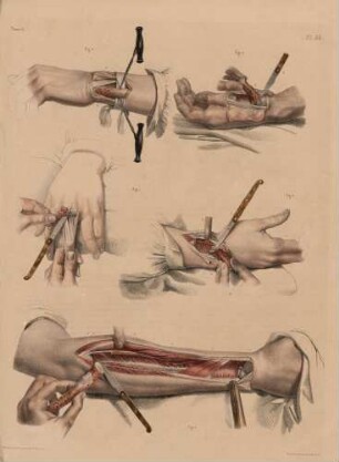 Verschiedene Resektionen der Knochenbestandteile des Thorax