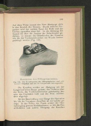 Fig. 125. Resektion des Ellenbogengelenkes.