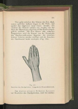 Fig. 127. Resektion des Handgelenkes. Langenbecks Dorsoradialschnitt.