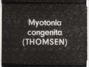 Myotonia congenita (Thomsen)