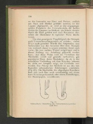 Fig. 69. Schematische Darstellung der Unterschenkelamputation nach Bier.