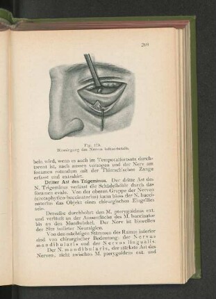 Fig. 175. Blosslegung des Nervus infraorbitalis.