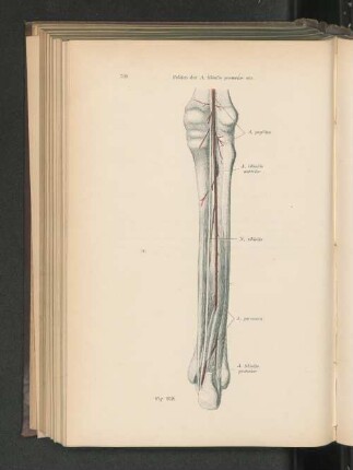 Fig. 618. Fehlen der A. tibialis posterior bis an das Ligamentum laciniatum.