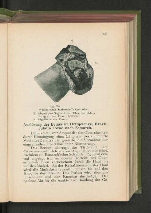 Fig. 99. Wunde nach Ssabanajeff's Operartion.