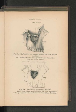 Fig. 9. Kieferhöhle von aussen geöffnet mit dem Ostium maxillare zu Communication mit dem Infundibulum der Nasenhöhle.