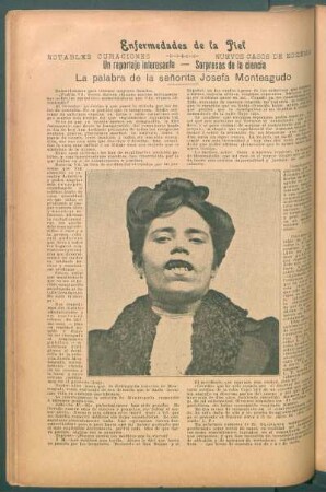 Enfermedad de la piel - Notables curaciones, nuevos casos de eczema : Un reportaje interesante, sorpresas de la ciencia - La palabra de la señorita Josefa Monteagrudo