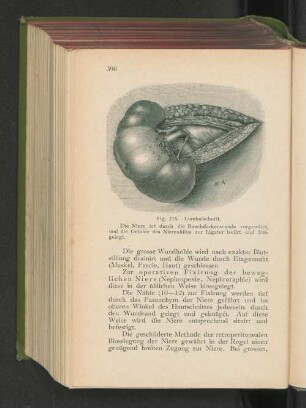 Fig. 216. Lumbalschnitt.