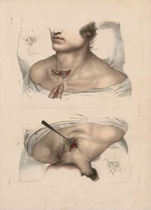 Ligatur des Truncus brachiocephalicus