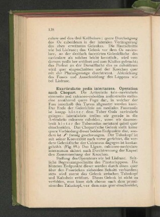 Exarticulatio pedis intertarsea. Operation nach Chopart.