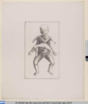 Anatomische Darstellung eines missgebildeten Kindes, auf dem Rücken liegend