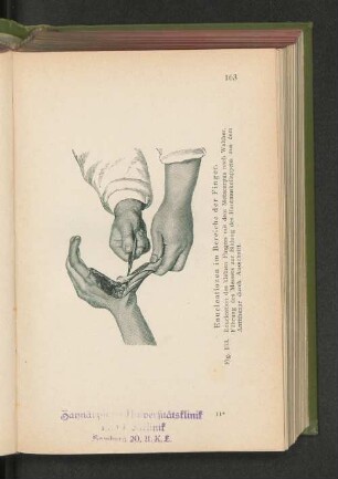 Fig. 103. Enucleationen im Bereiche der Finger.
