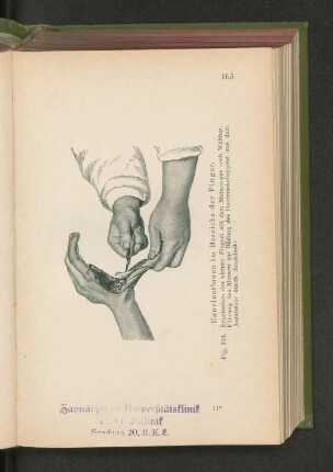 Fig. 103. Enucleationen im Bereiche der Finger.