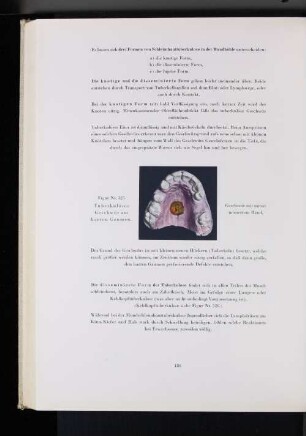 Figur Nr. 325 Tuberkulöses Geschwür am harten Gaumen.