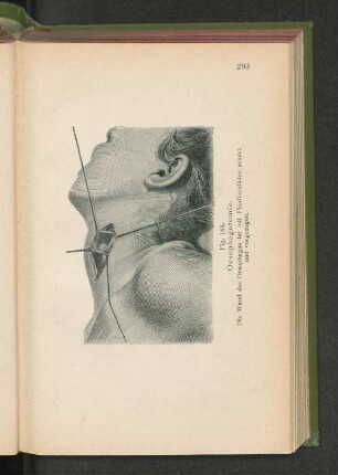 Fig. 185. Oesophagotomie.