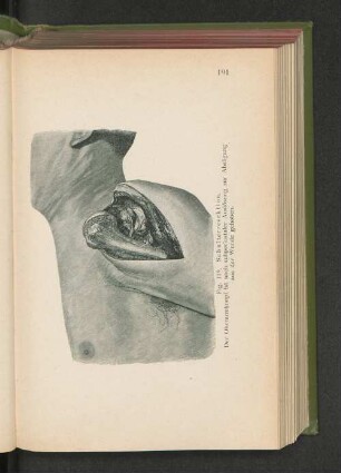 Fig. 119. Schulterresektion.