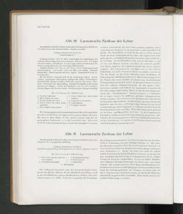 Abb. 90 Laennesche Zirrhose der Leber