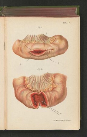 Fig. 1. Von der Serosaseite her angelegte Darmnähte.