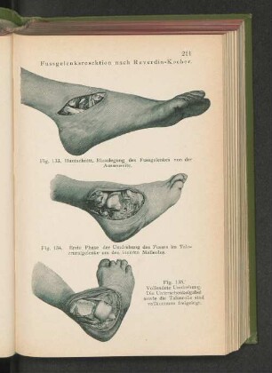 Fig. 133. Hautschnitt. Blosslegung des Fussgelenkes von der Aussenseite.